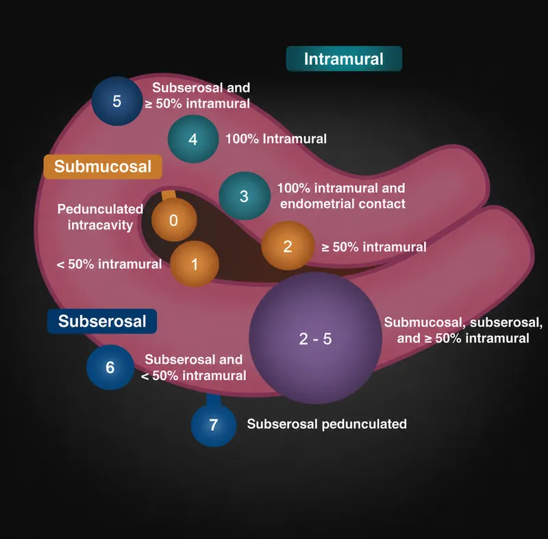 FIGO classification of leiomyomas