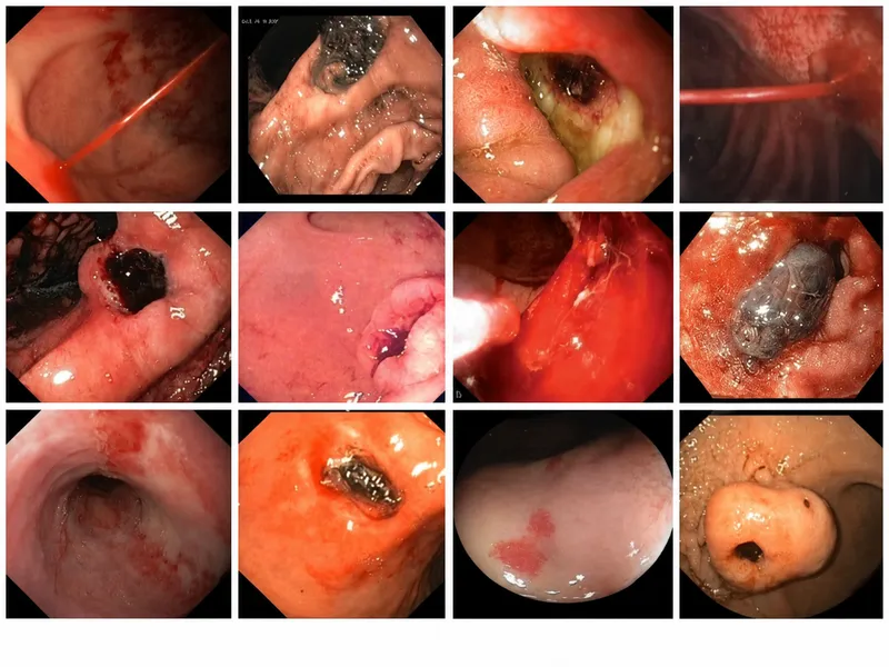 Endoscopic views of non-variceal UGI bleeding lesions