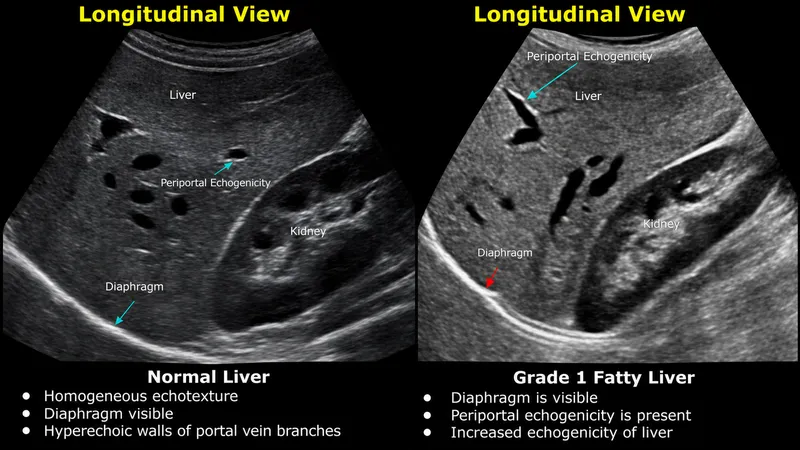 Normal vs Grade 1 Fatty Liver Ultrasound