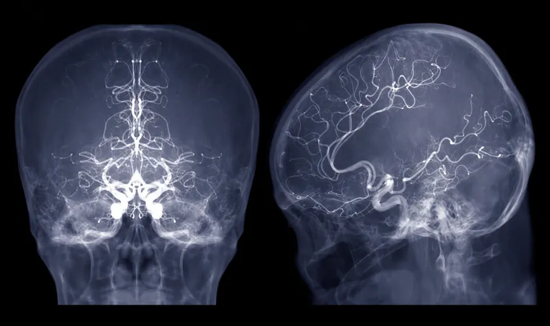Cerebral angiogram showing Circle of Willis (AP view)
