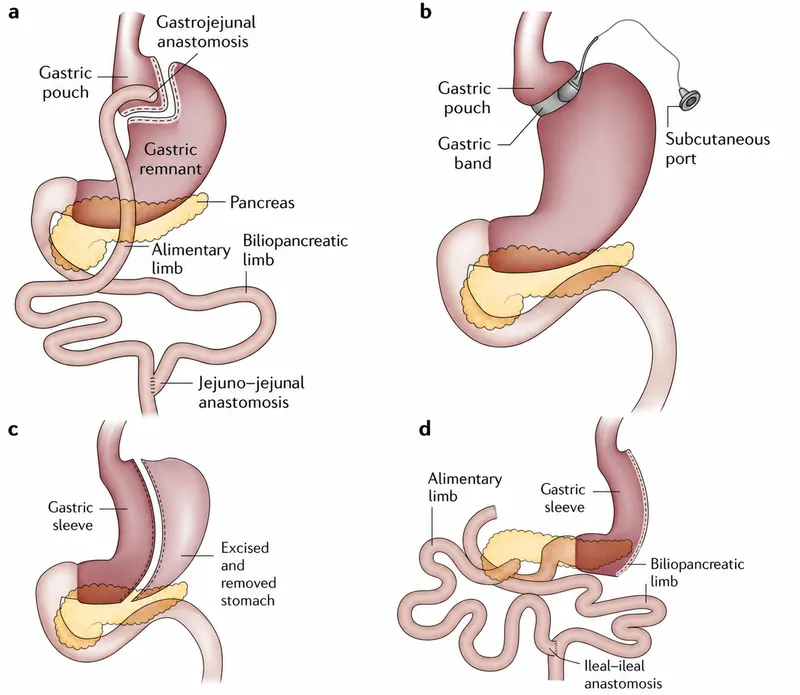 Restrictive Bariatric Surgery Procedures