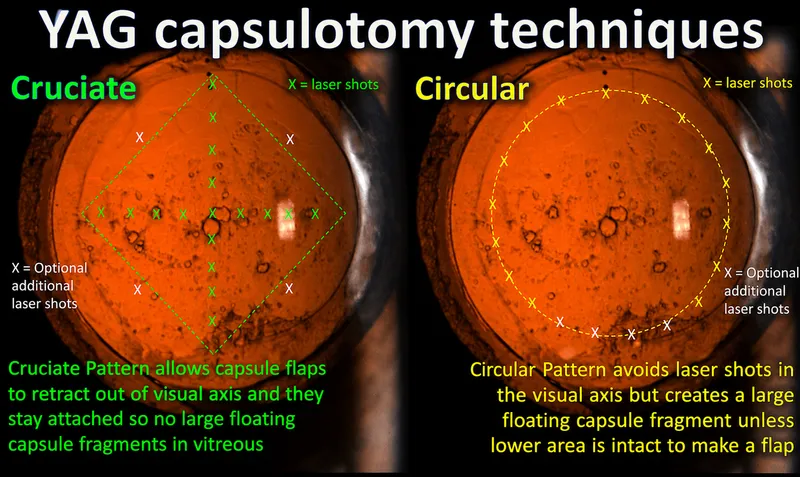 YAG capsulotomy techniques