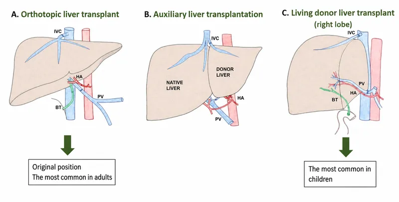 Liver Transplant Surgical Techniques