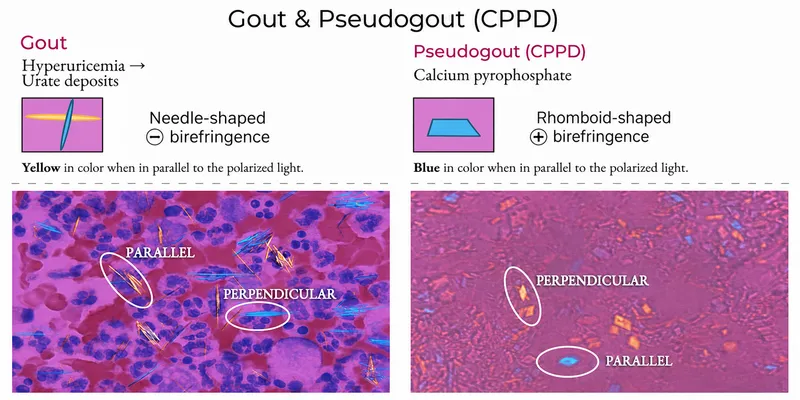 Gout vs. Pseudogout: Crystal Microscopy & Birefringence