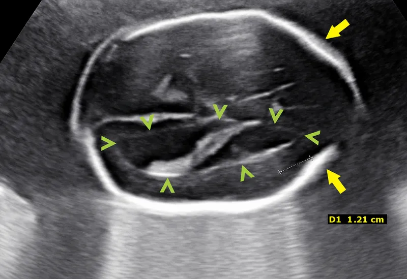 Fetal US: Lemon & banana signs of open spina bifida