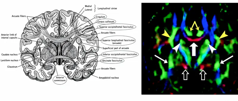 Coronal brain view: white matter tracts & DTI