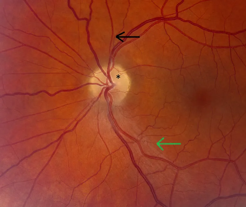 Figure 1: Fundoscopy showing arteriovenous nipping and silver wiring in hypertensive retinopathy