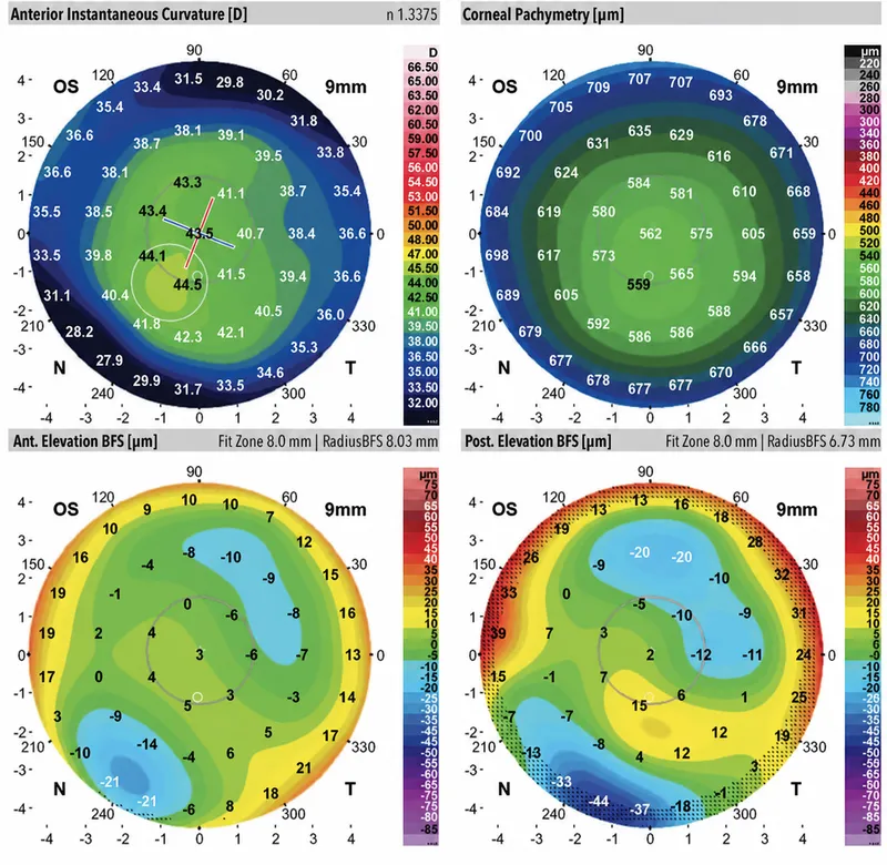 Detailed corneal topography showing anterior and posterior surface curvatures