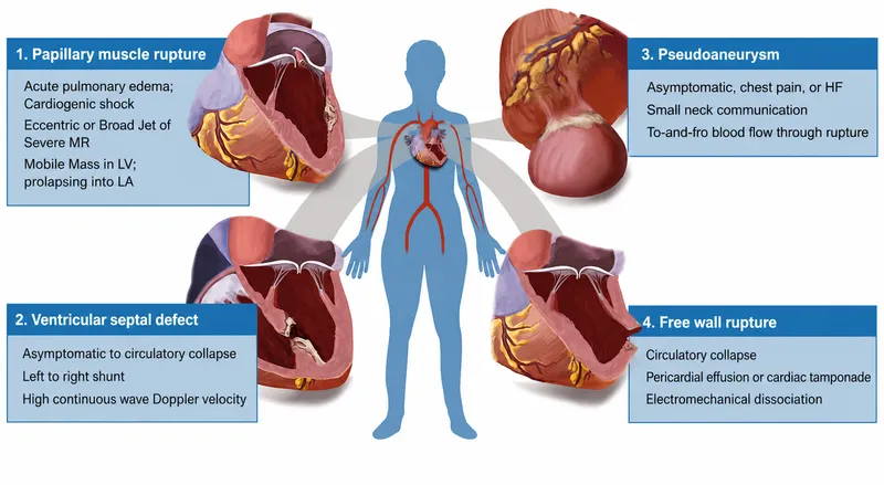 Post-MI Mechanical Complications: Ruptures & Defects