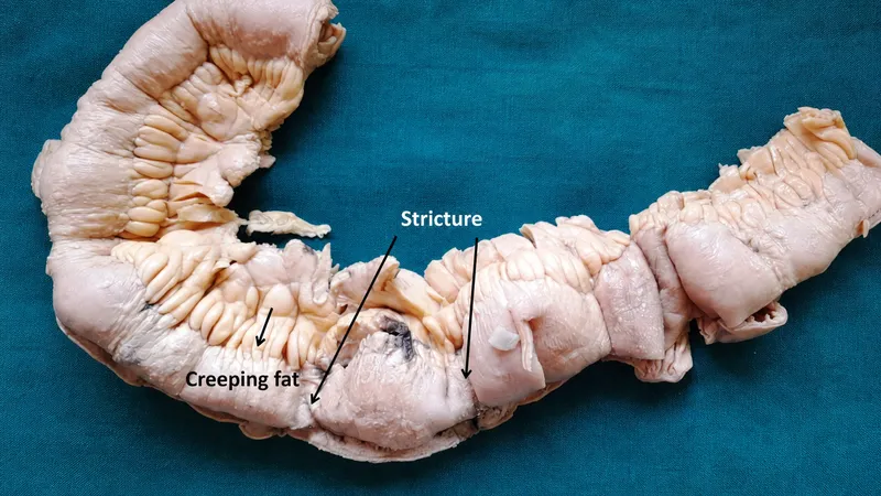 Crohn's disease gross pathology: stricture & creeping fat