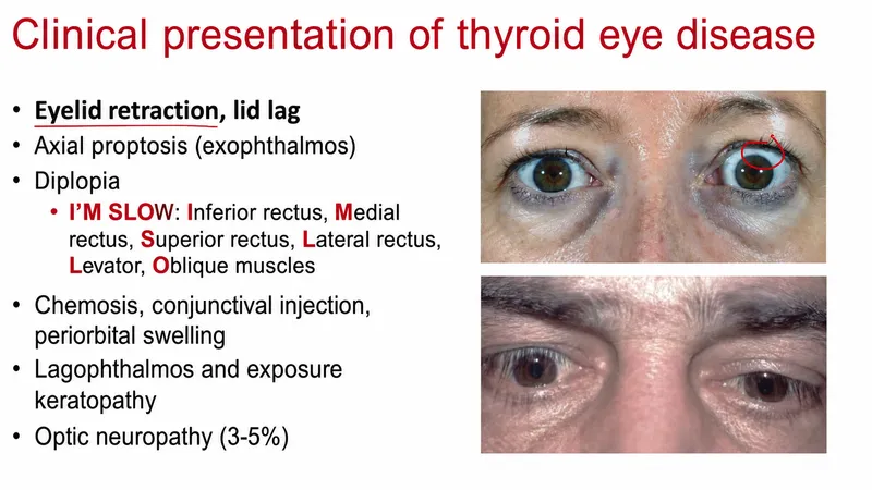 Clinical signs of Thyroid Eye Disease