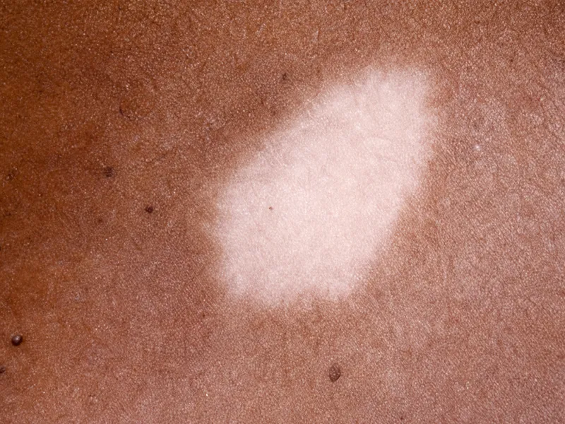 Post-inflammatory hypopigmentation