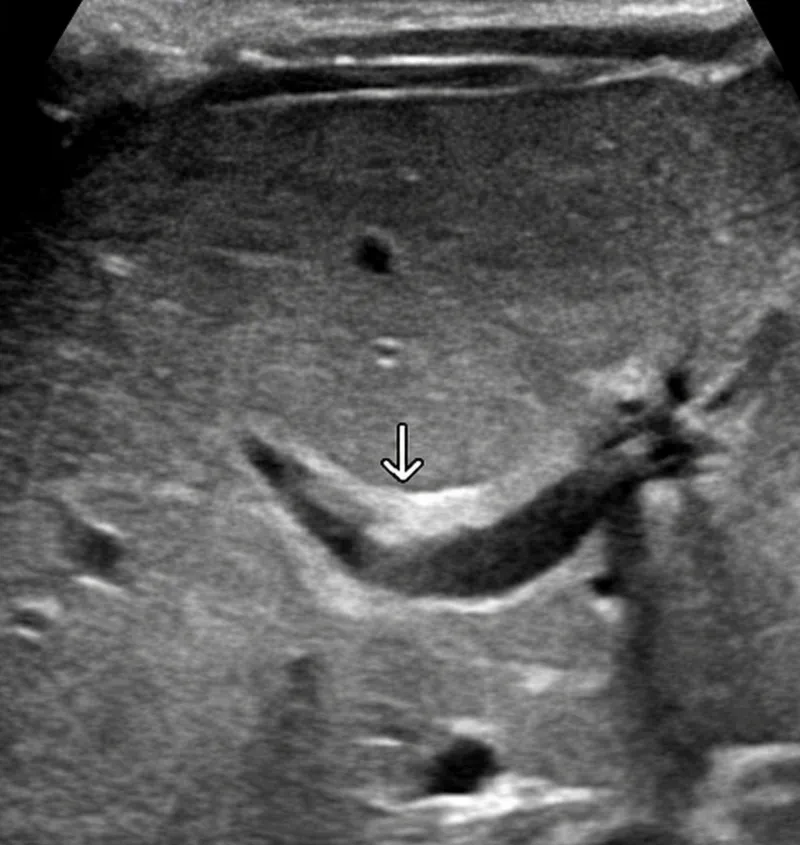 Ultrasound: Triangular cord sign in biliary atresia