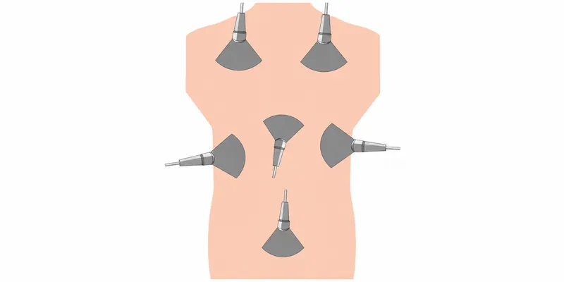 eFAST Ultrasound Windows Diagram