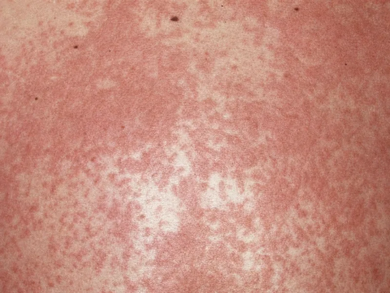 Autoeczematization: Symmetrical papulovesicular eruption