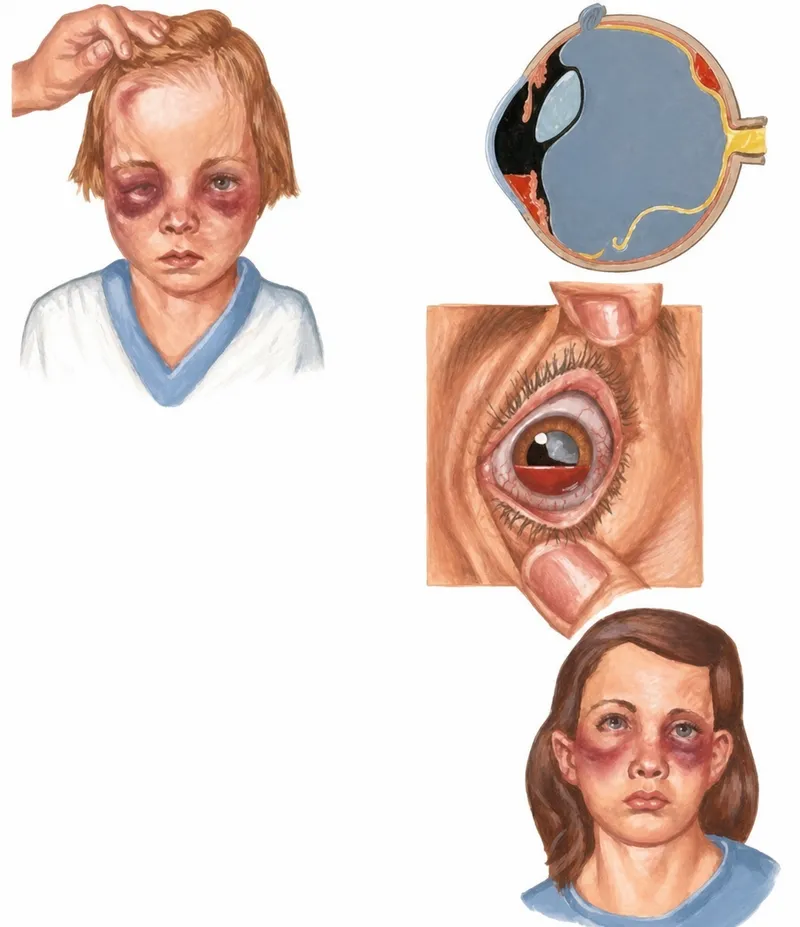 Ocular Manifestations of Child Abuse