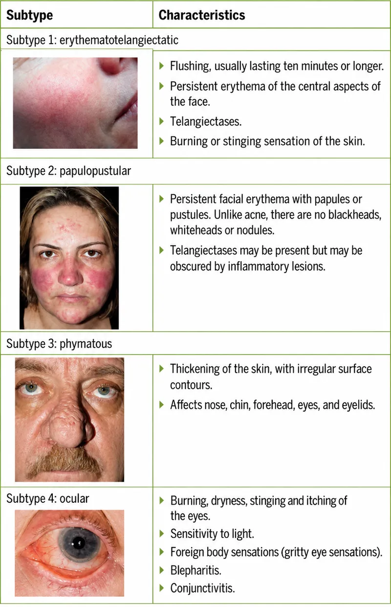 Rosacea Subtypes and Characteristics