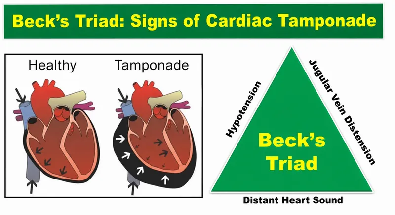 Beck's Triad and Cardiac Tamponade Comparison