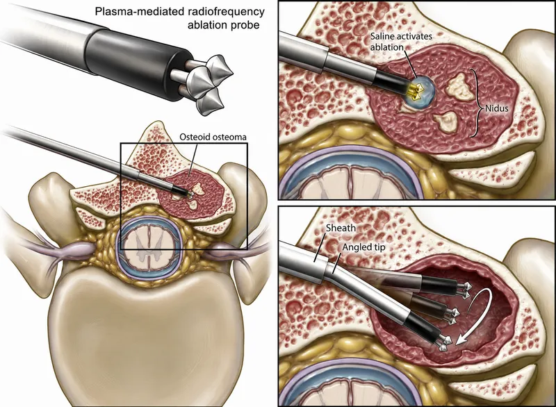 RFA probe targeting osteoid osteoma nidus