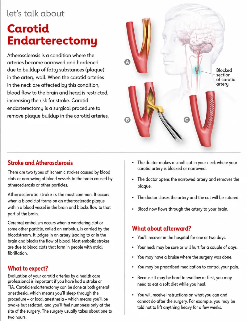 Carotid Endarterectomy: Plaque Removal & Blood Flow