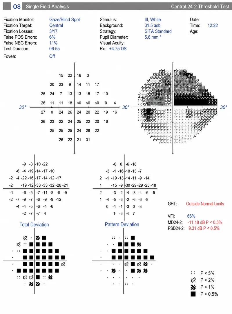 Humphrey Visual Field Printout