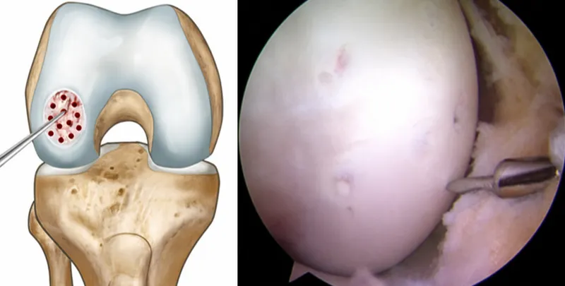 Microfracture treatment of chondral defect