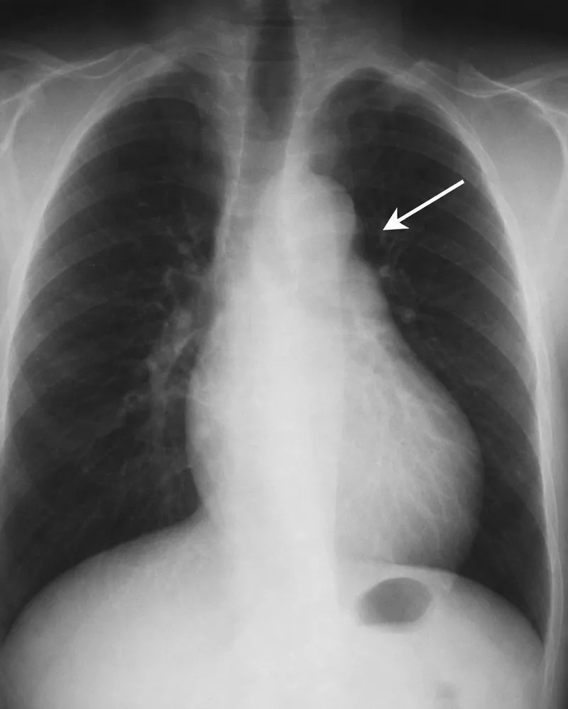 CXR in PDA with pulmonary plethora and LA enlargement