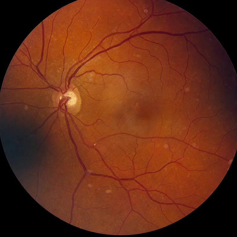 Fundus: CRVO blood and thunder appearance