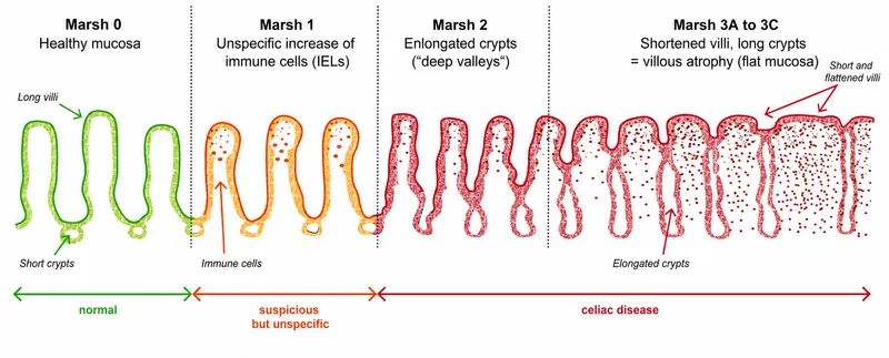Marsh Classification of Celiac Disease Histology