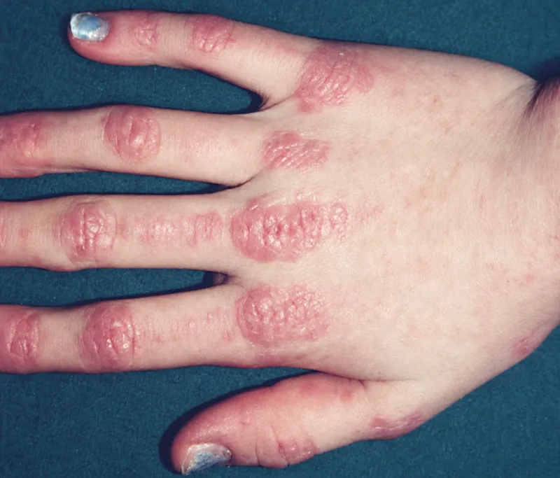 Gottron's papules on hand in dermatomyositis