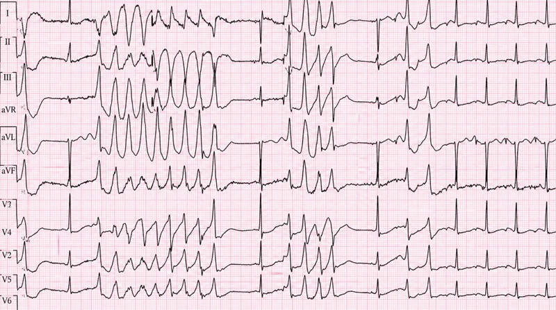 ECG: VT, VF, and Torsades de Pointes