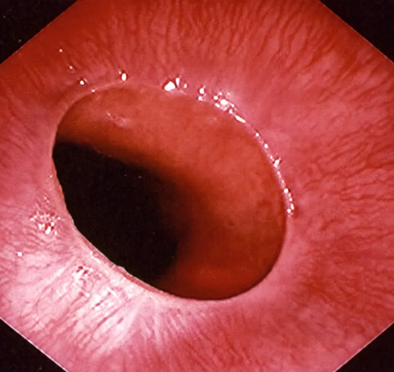 Endoscopic view of esophageal Schatzki ring
