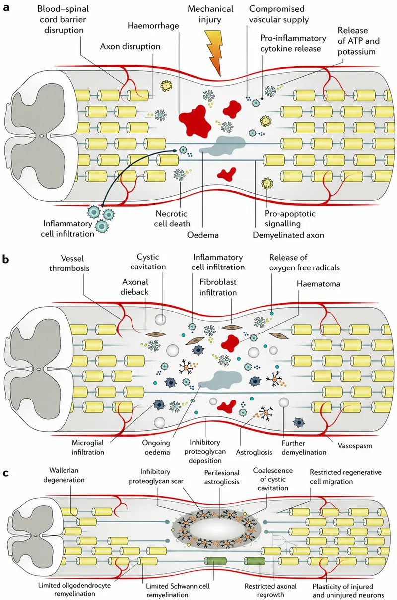 Spinal Cord Injury: Primary and Secondary Injury Mechanisms