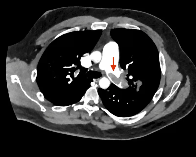 CTPA: Saddle Pulmonary Embolus