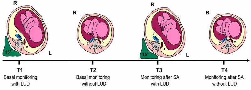 Aortocaval compression in pregnant patient with/without LUD