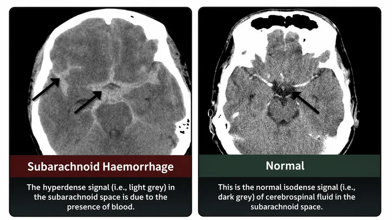 CT scan: subarachnoid hemorrhage vs. normal