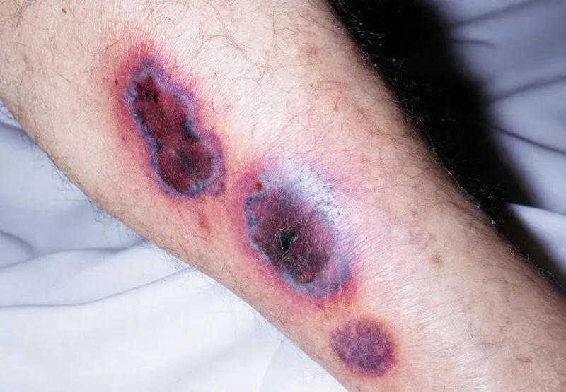 Ecthyma gangrenosum from Pseudomonas aeruginosa