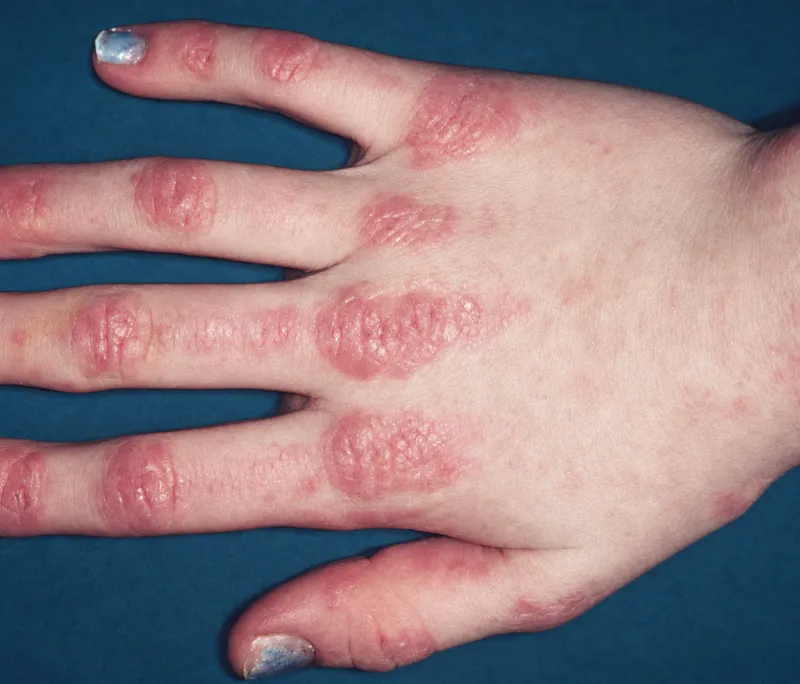 Gottron papules on hand in dermatomyositis