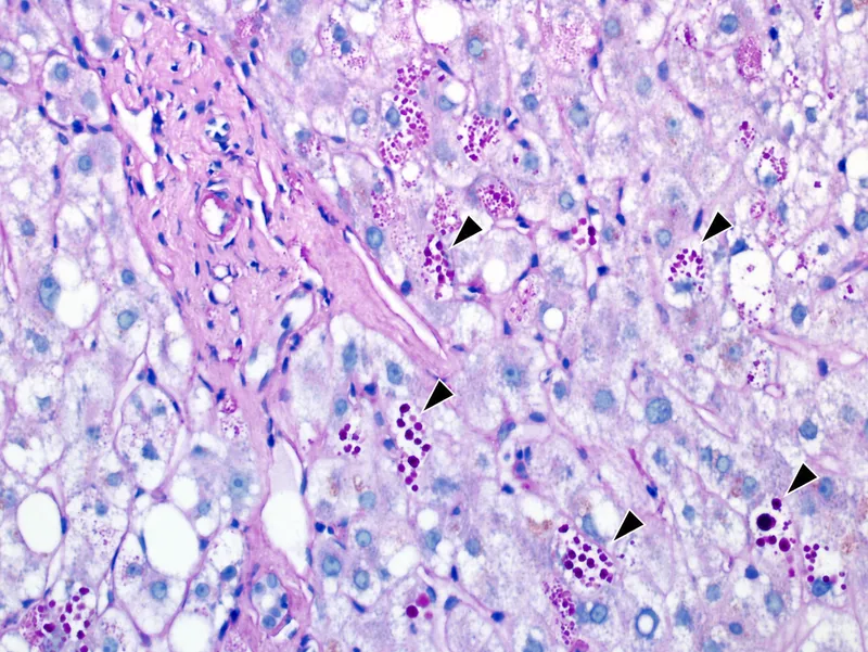 Alpha-1 Antitrypsin Deficiency: PAS-D Positive Globules