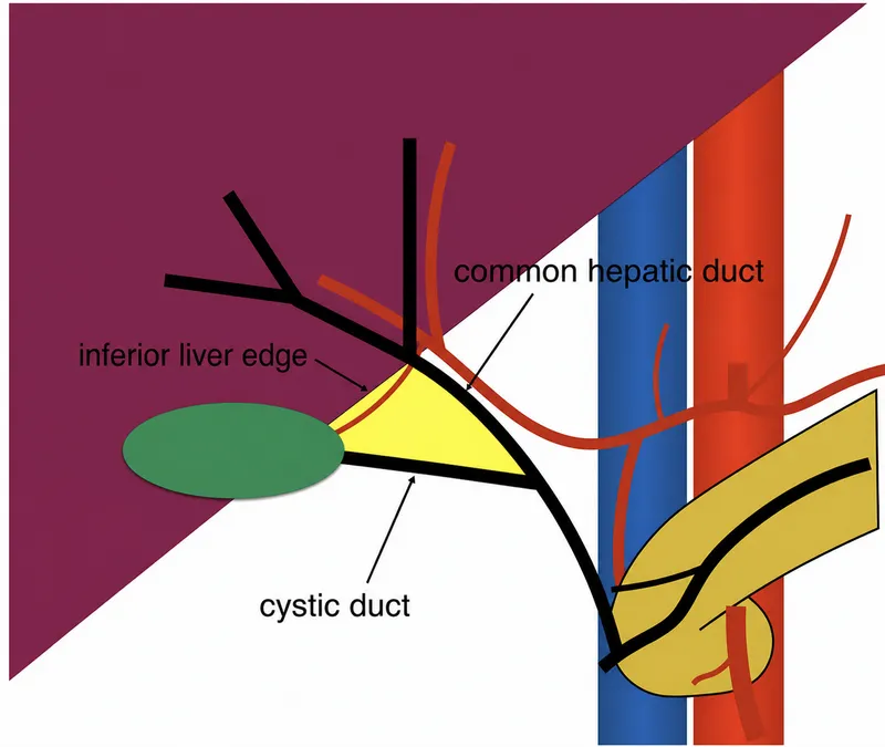 Calot's Triangle Anatomy
