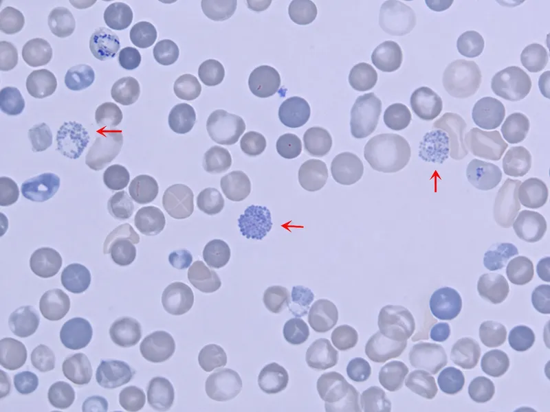 Peripheral smear of HbH disease with golf ball cells