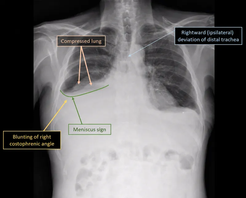 Chest X-ray: Pleural effusion with meniscus sign