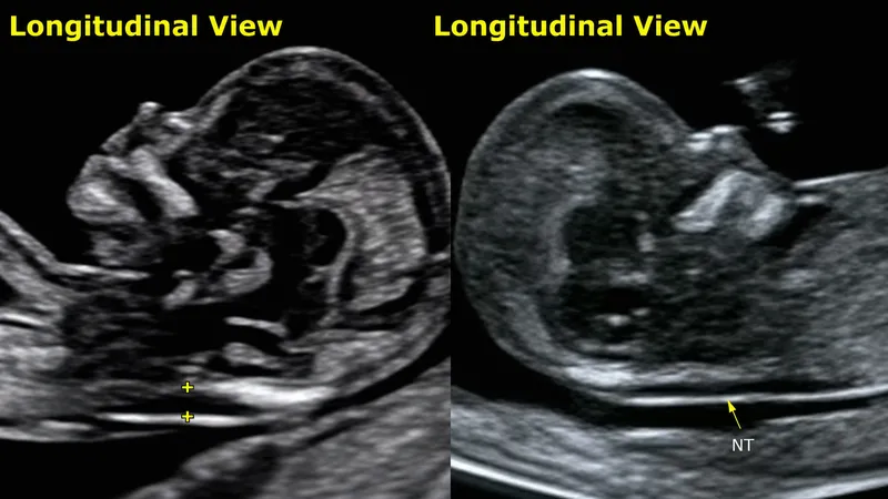 Fetal Nuchal Translucency Ultrasound Measurement