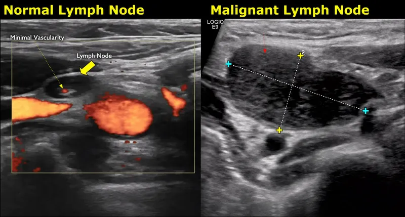 Ultrasound: Normal vs Malignant Cervical Lymph Node