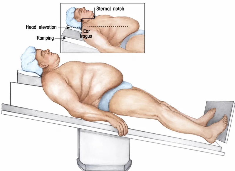 Ramp Position for Preoxygenation in Obese Patients