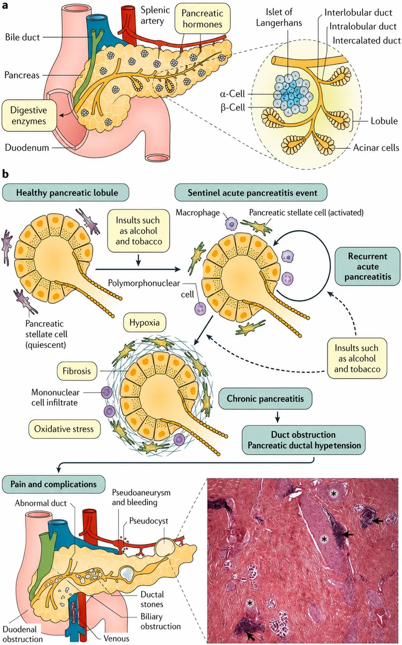 Chronic Pancreatitis Histopathology
