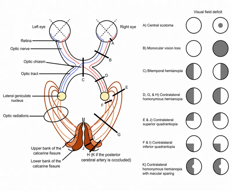 Visual Field Defects and Lesion Locations
