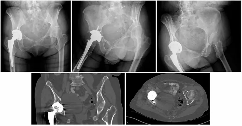 Periprosthetic osteolysis after total hip arthroplasty