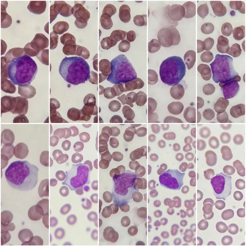 Atypical lymphocytes (Downey cells) in peripheral smear