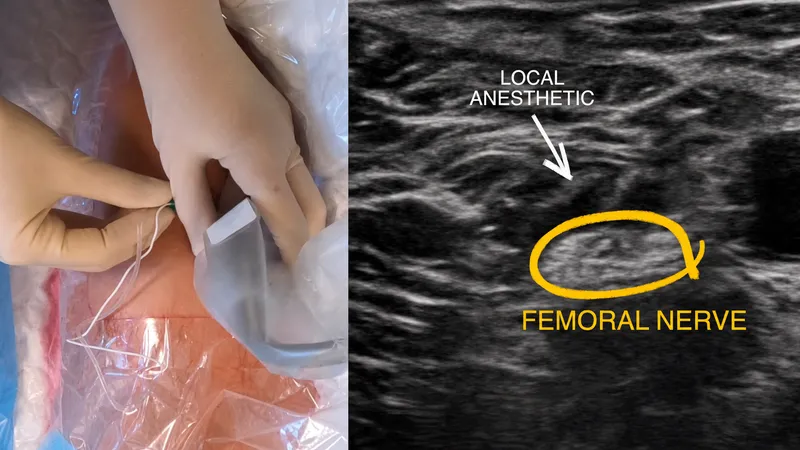 USG-guided Femoral Nerve Block